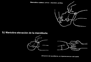 cardiorespiratory arrest