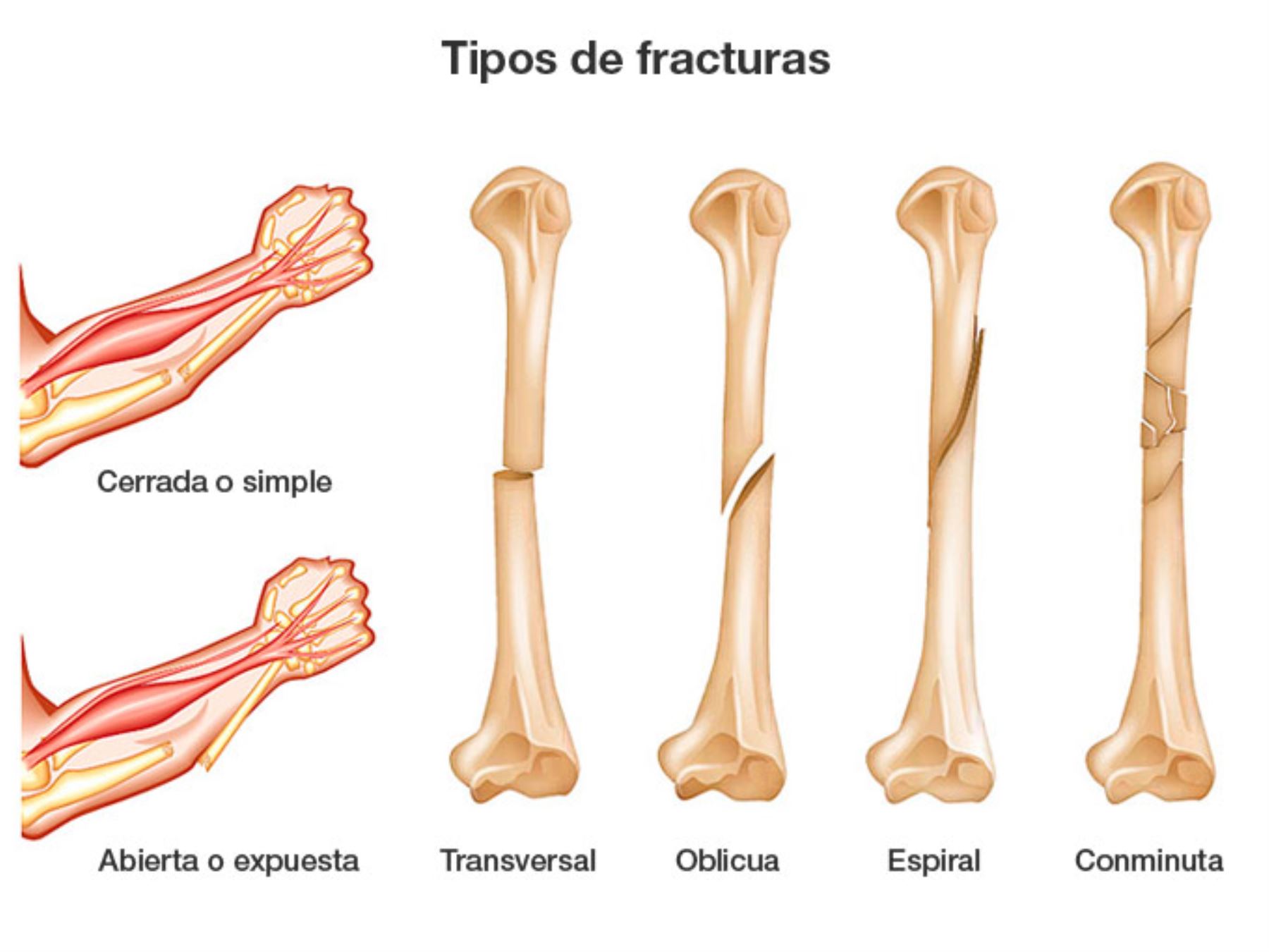 Fracture